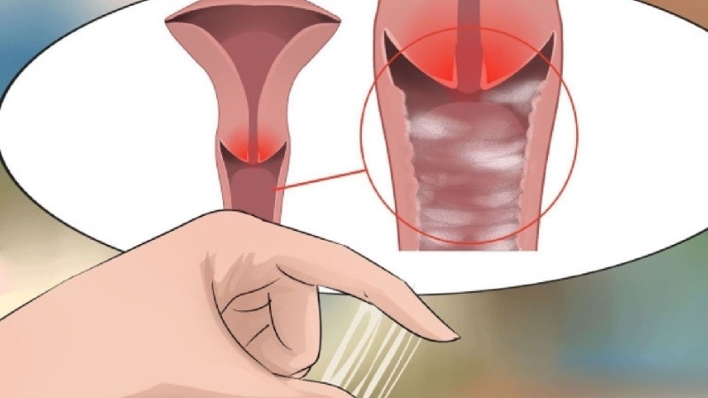 Dấu hiệu bị viêm âm đạo